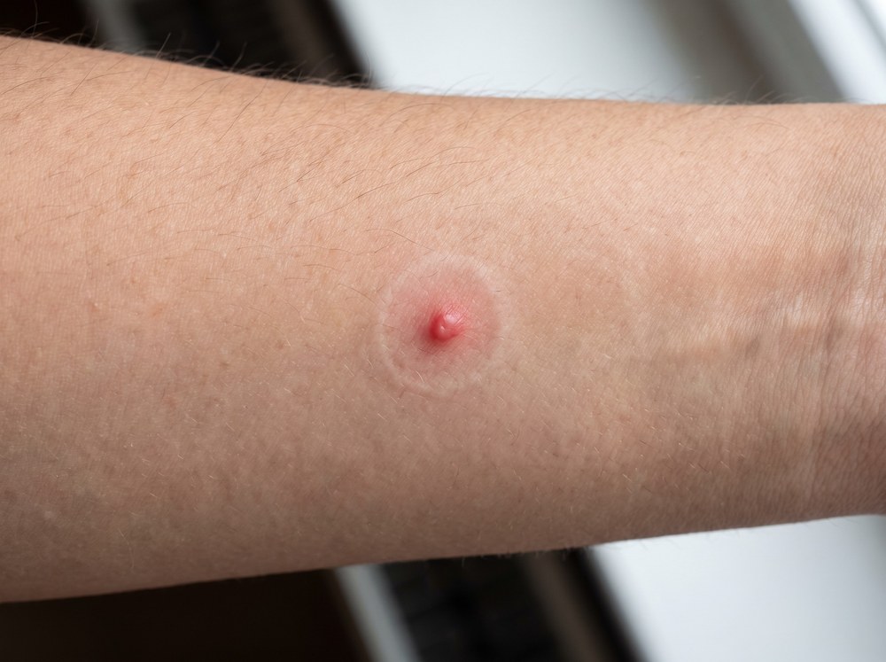 Close-up of a mild skin rash with small clustered red bumps on a forearm consistent with contact dermatitis rather than an insect bite