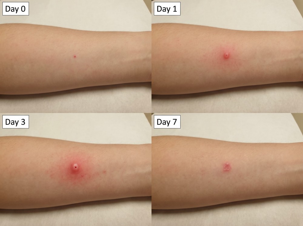 Four-panel comparison photo showing the progression of a mild skin reaction from Day 0 through Day 7 of home care